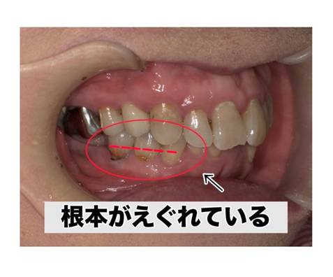 根本がえぐれている