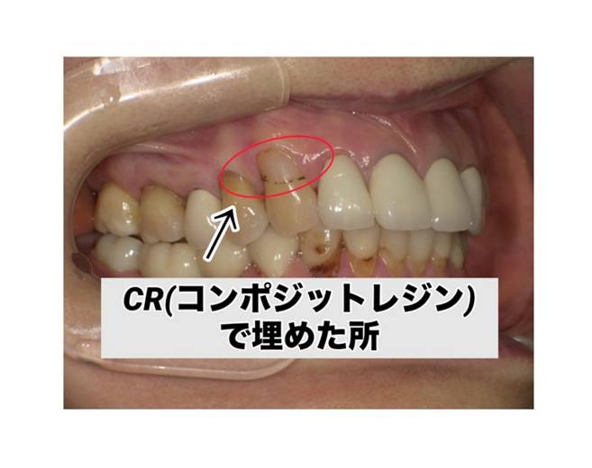 CR
CRでつめた所