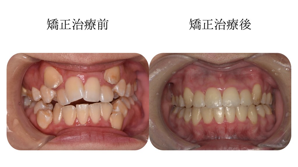 矯正治療前
矯正治療後