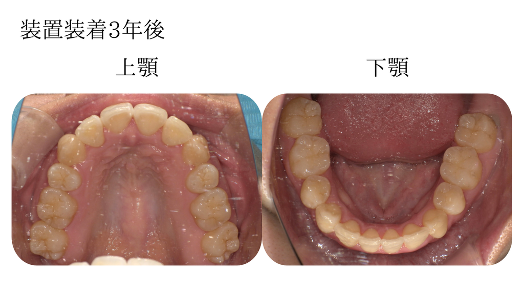 矯正装置3年後